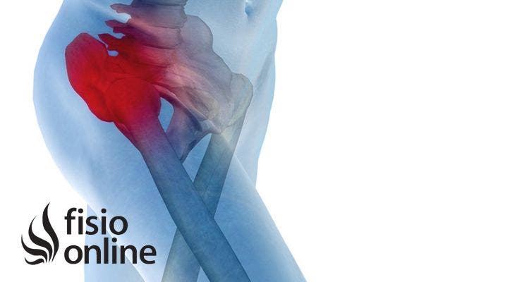 Dolor cadera ingle muslo rodilla